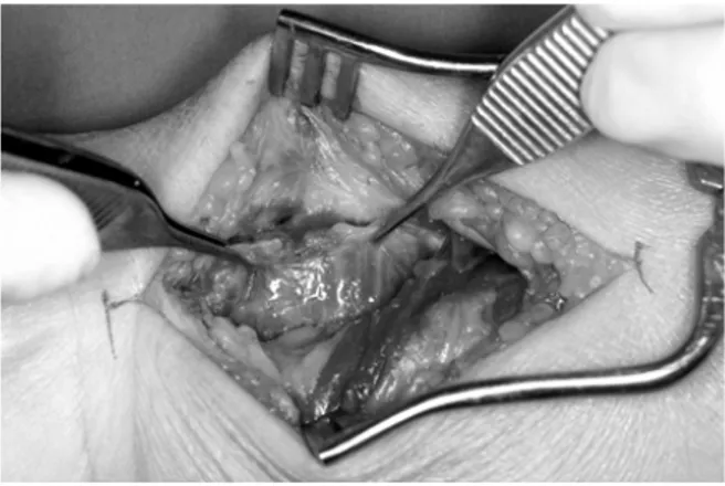 Fig. 9. The pronator quadrates is elevated from the lateral  edge of radial orign.