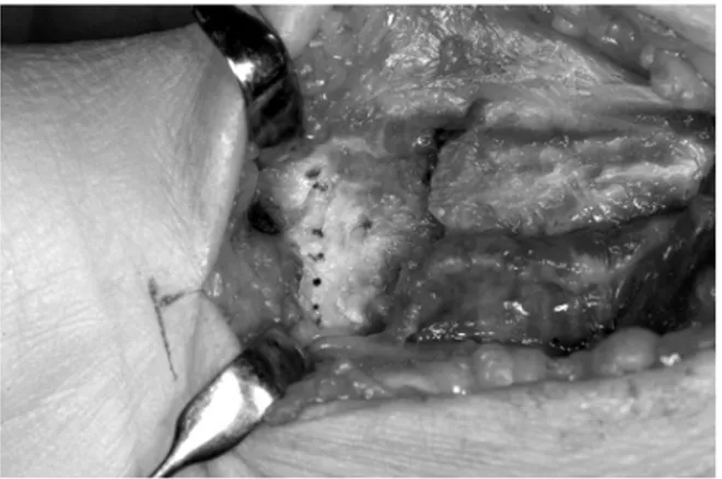 Fig. 10. A dotted line indicates transverse ridge, and the  fracture site is exposed after elevation of pronator quadratus.