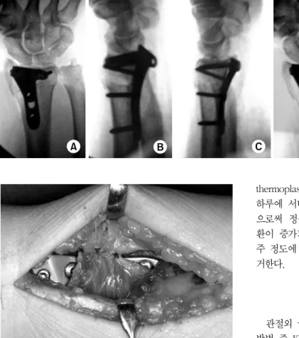 Fig. 12. The pronator quadrates should be reattached its  orign site.