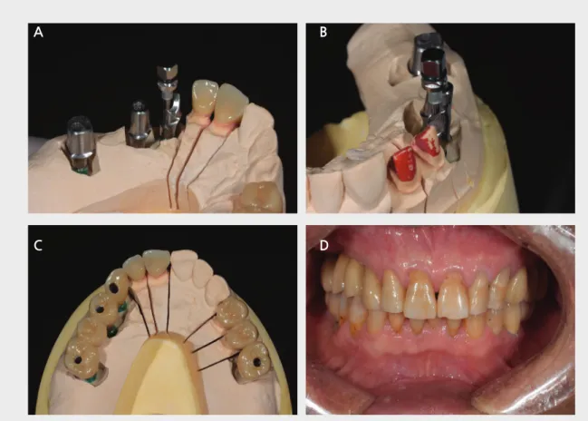 Fig. 1.  A,B,C,B: #13부위의 임플란트가 절단부보다 순측경사되어 일반적인 screw hole의 방향은 순측에 형성되는 상황이지만 angled screw 를 사용하여 screw를 설측에서 체결할수 있도록 보철물을 디자인 할 수 있다