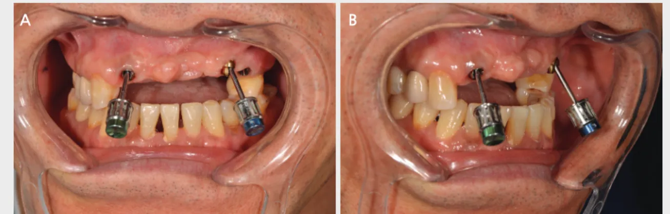 Fig. 3. A,B Angled multiunit abutment를 체결하고 난 모습. 기존 임플란트의 심한 순측경사정도를 알 수 있다.