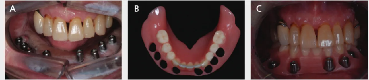 Fig. 6. A,B : 재건후 적절한 안모의 회복이 이루어졌으며 고정성 보철을 위해 잔존 하악골에 임플란트를 식립 A A CBB