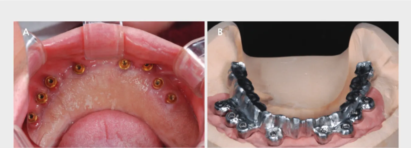 Fig. 8.  A,B. Multiunit abutment (Screw abutment)를 연결하고 cobalt chrome금속을 밀링하여 one-piece framework제작후 porcelain build-up 시행하였다