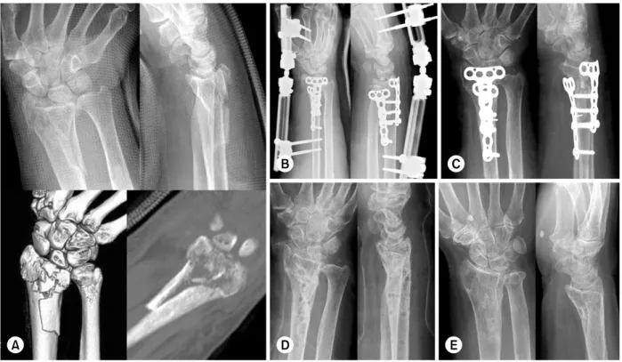 Fig. 4. (A) Sixty-nine year old female patient had broken her right wrist, with severe intraarticular fracture of distal radius