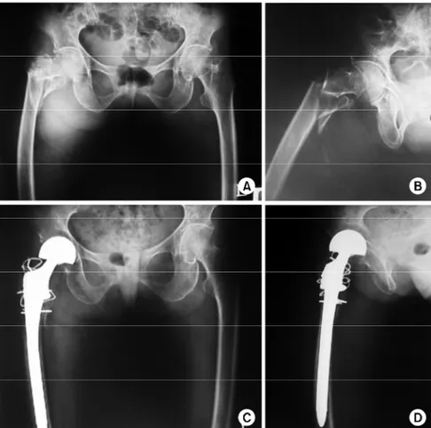 Fig.  2.  (A,  B)  Both  hip  anteropo- anteropo-sterior  and  right  hip  lateral   radio-graphy  of  75  year-old  female   pa-tient  shows  Evans  unstable  femoral  intertrochanteric  fracture