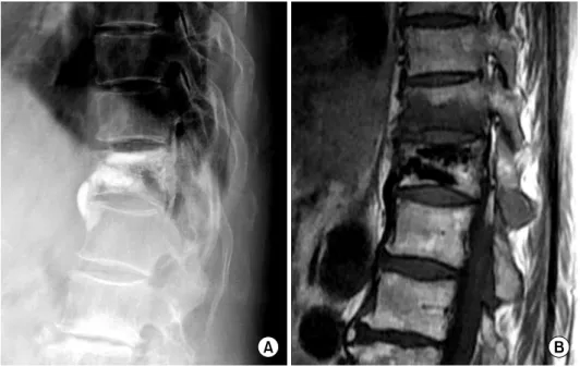 Fig. 3. 72 year-old female vi- vi-sited in our hospital because  of back pain after  vertebro-plasty of T12 Without trauma  history