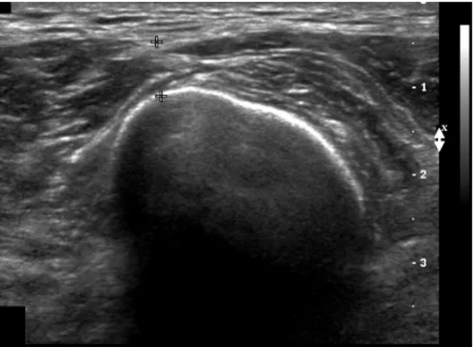 Fig. 4. Sonogram shows 10×6 cm mass in the medial aspect  of the thigh as like hematoma or abcess.