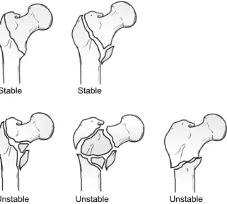 Fig. 1. Evans classification of intertrochanteric fracture.서        론    대퇴  전자간  골절은  주로  고령층에서  발생하며,  최근 의학의  발전과  함께  평균  수명의  증가로  그  발생  빈도가 증가  추세에  있다