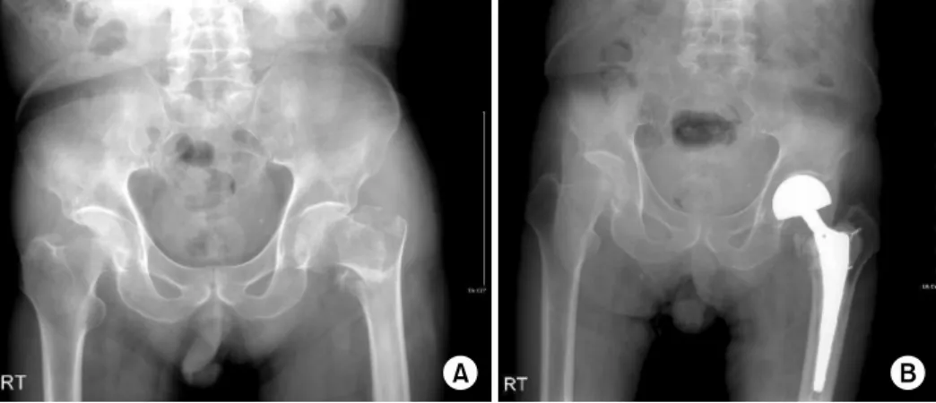 Fig. 3.  (A)  Preoperative radio- radio-graph of a 72-year-old male  showing unstable  intertrochan-teric fracture according to  Evans classification.