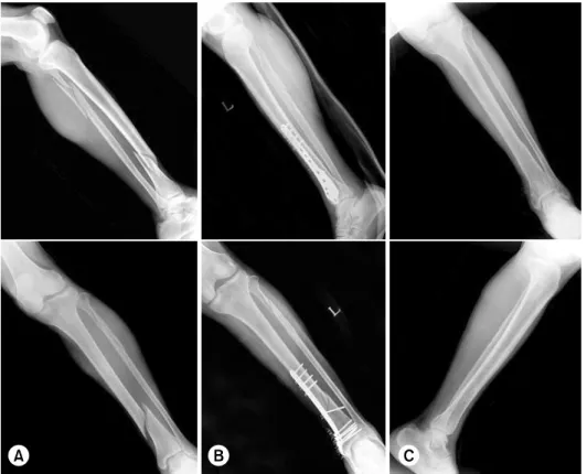 Fig. 3. A 70 year old man  sustained a fracture of left  distal tibia after traffic  acci-dent