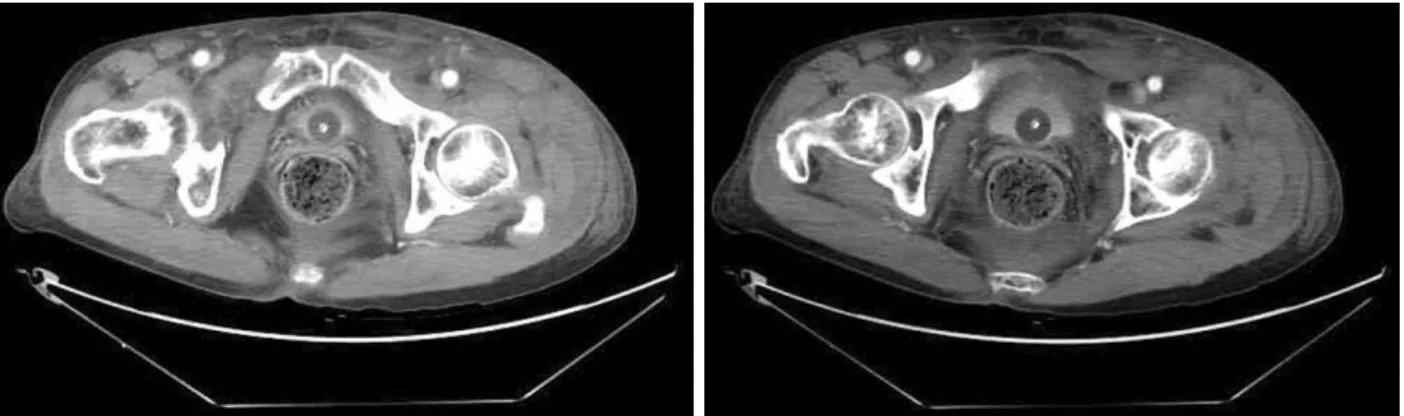 Fig. 3. CT findings confirm the concentric reduction and excluded any intra-articular fragments.