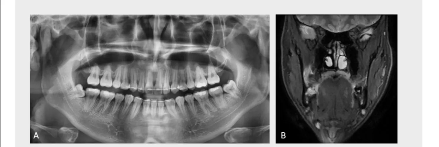 Figure 1.   A. Panoramic radiography before extraction of right mandibular 3rd molar. B