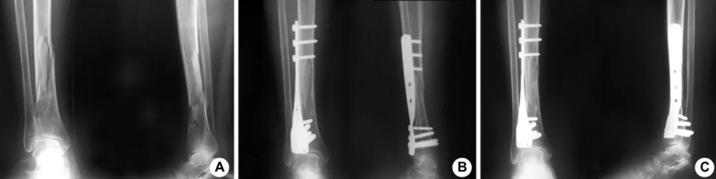 Fig. 2. Serial AP and lateral Roenterograms of distal tibial metaphyseal comminuted fracture