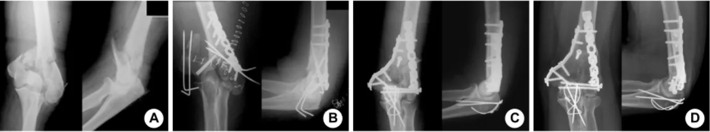 Fig. 3. Type A2 fracture of the distal humerus by a simple fall in a 75-year-old woman.