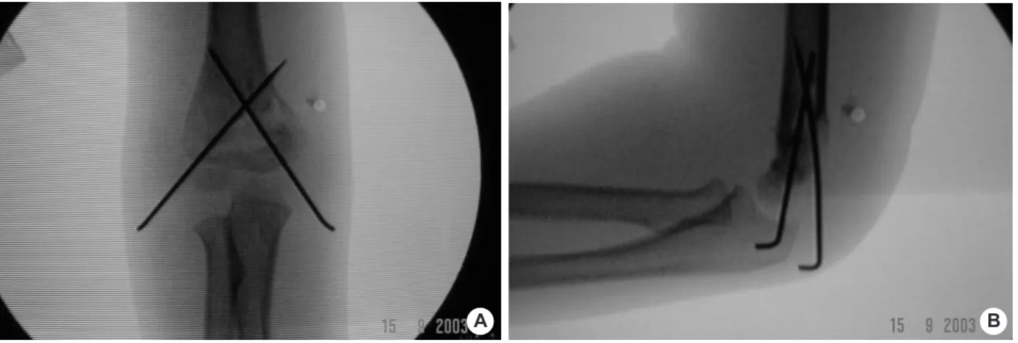 Fig. 3. (A, B) Anteroposterior and lateral view in C-arm image intensifier show percutaneous K-wires fixation was completed.