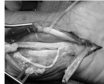 Fig. 2. Intraoperative finding shows total rupture of flexor digitorum profundus tendons of the middle and ring fingers and partial rupture of the flexor digitorum superficialis tendon of the ring finger.
