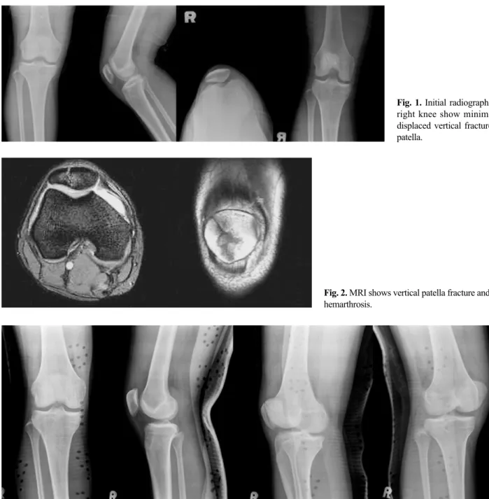 Fig. 2. MRI shows vertical patella fracture and hemarthrosis.