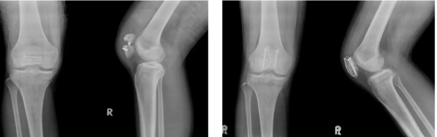 Fig. 5. The fracture was reduced and fixed with two vertical can- can-nulated screws and figure of 8 wire.