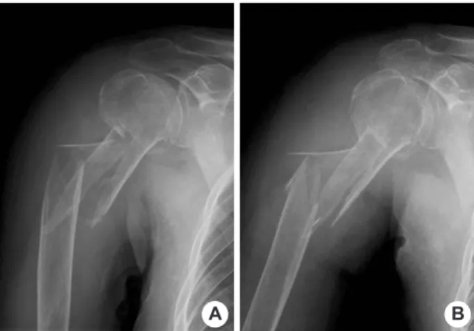 Fig. 1. Initial radiographs show a segmental comminuted fracture of the proximal humerus with severe osteoporosis.