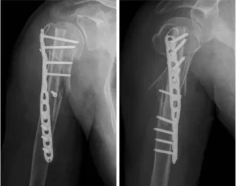 Fig. 5. Photographs show forward flexion of the shoulder joint to 155 degrees at the final follow-up.