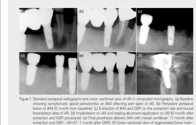 Figure 1.   Standard periapical radiographs and cross-sectional view of i45 in computed-tomography