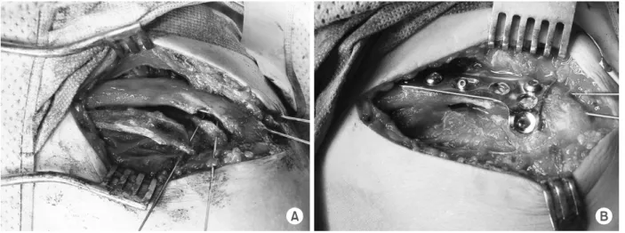 Fig. 1. (A) Comminution of fracture site and inferior fragment are noted. 