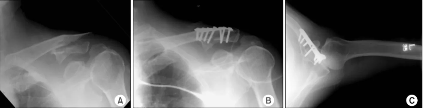 Fig. 2. Loosening of a screw on transverse portion of T plate is seen.