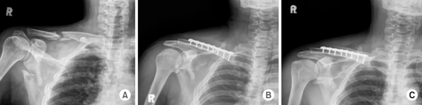 Fig. 1. Simple fractures as group A, and comminuted fractures  as group B with subgroup of 1, 2, and 3 according to their  displacement, angulation and degree of comminution.