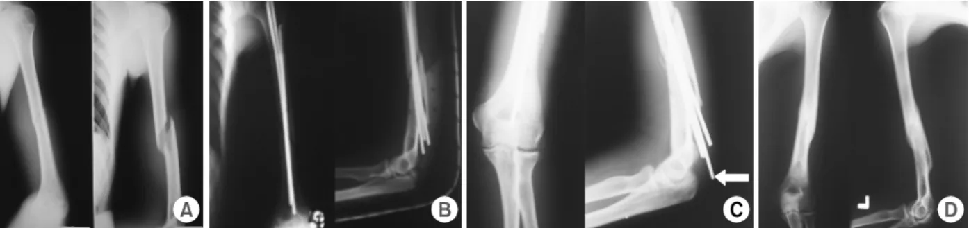 Fig. 1. Schematic presentation of operative procedure. Place  the patient prone position with the elbow in 90 o  flexion