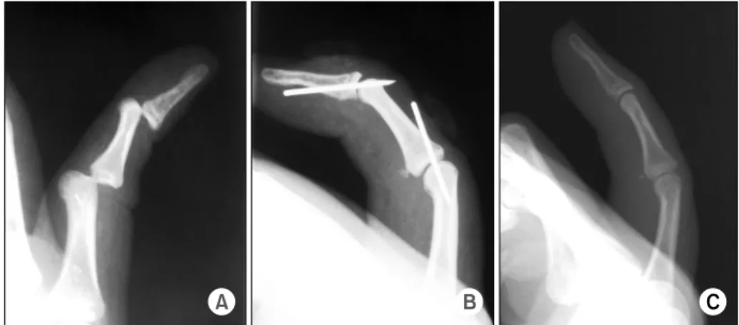 Fig. 1. Plain lateral radiograph of 5 th  finger of right hand of case 1.