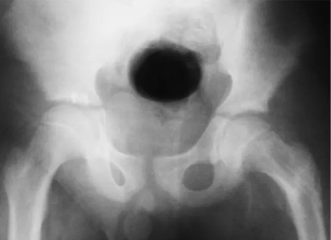 Fig. 3. Radiograph after removal of cannulated screws shows  complete union of femoral neck fracture.