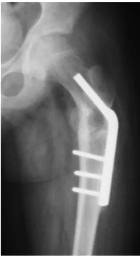 Fig. 6. Radiograph after slip down shows subtrochanteric frac- frac-ture.