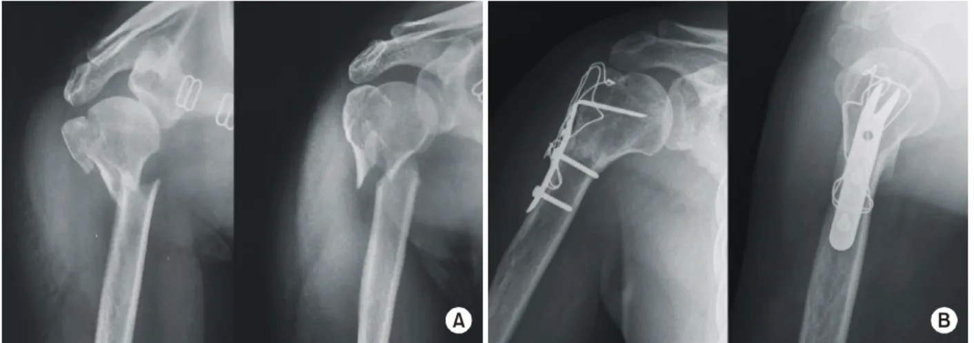 Fig. 4.  (A) Initial radiographs show 2-part proximal humerus fracture in a 49-year old male patient.