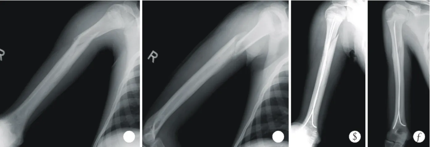 Fig. 1. Case 1. Mid to distal shaft fractures of the humerus with butterfly fragment by arm wrestling in a 26-year-old man