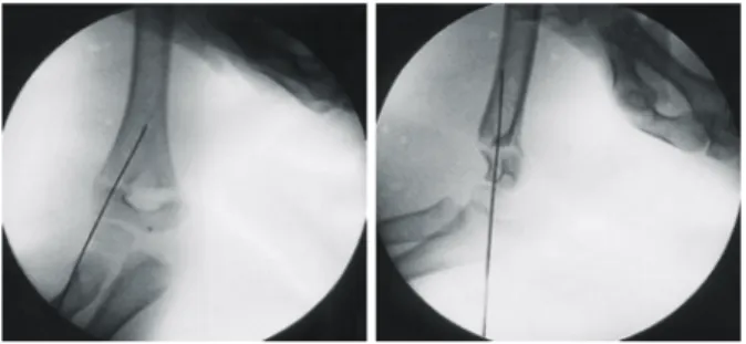 Fig. 1. First step of the procedure. An initial fine K-fire was inserted through the distal fragment of fracture at the lateral  aspect of elbow joint.