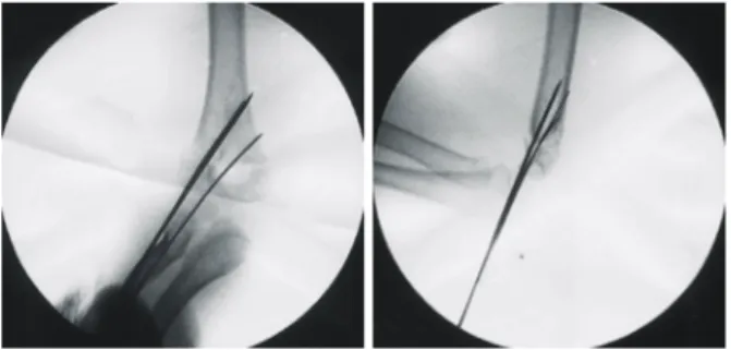 Fig. 4. Last step of the procedure. After fixation of the 2nd  K-wire, the initial K-wire is retracted over the fracture line  and then re-advanced or replaced with a thicker K-wire