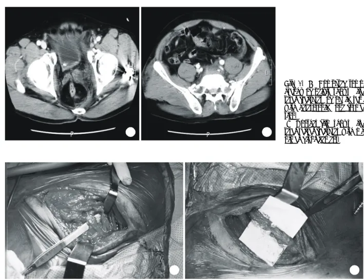 Fig. 3. The sciatic nerve was adhesed to surrounding tissues and located anteriorly than its normal course.