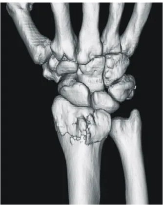 Fig. 6. 3D-CT is a good diagnostic tool for the intraarticular  fracture of the distal radius and is very helpful for the  preoperative  planning of fracture management.