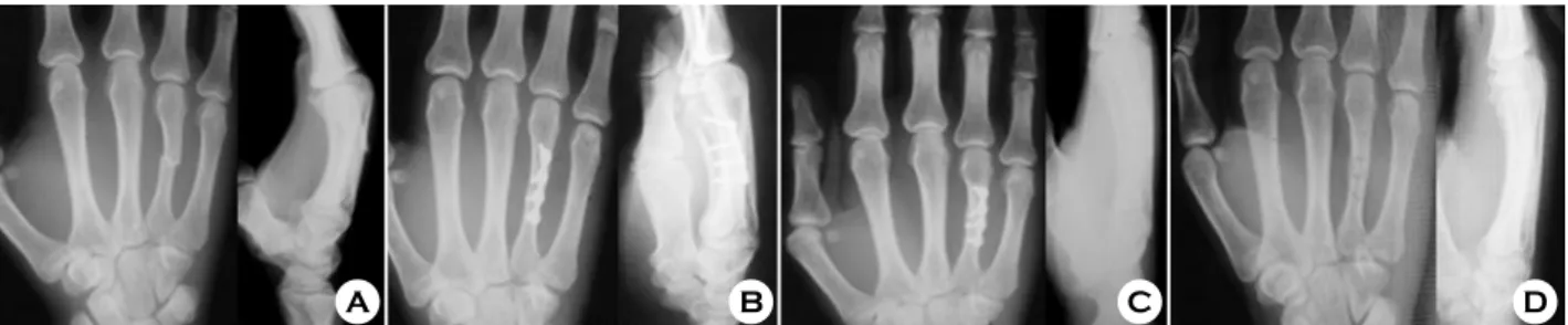 Fig. 2. (A) Initial radiographs of  fourth metacarpal shaft fracture. 