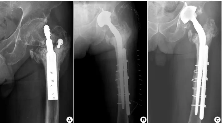 Fig. 3. (A) Case #3, 64/M, POD #1yr, failed internal fixation with cutting out. 