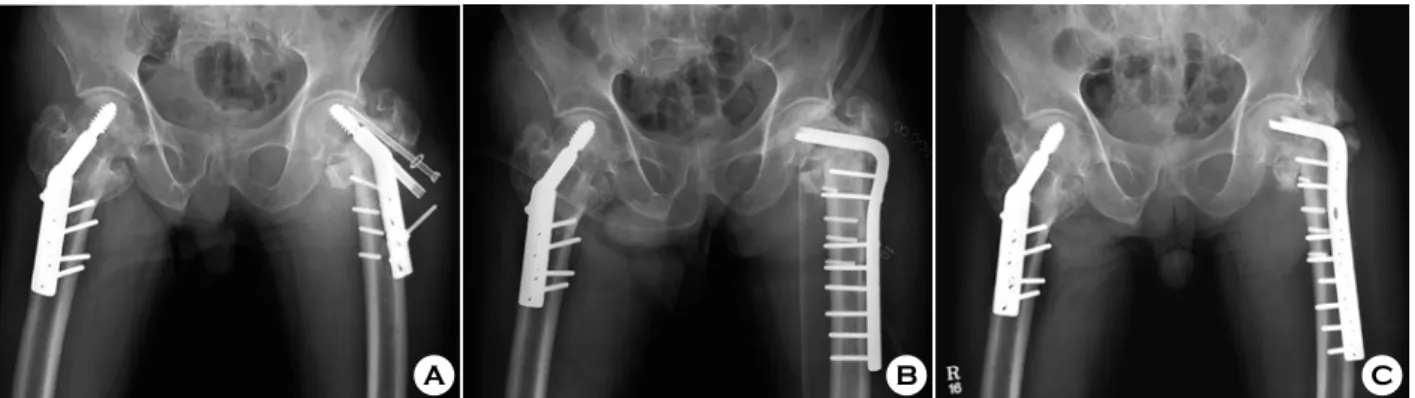 Fig. 4. (A) Case #4, 72/M, POD #8 months, failed fixation with varus collapse impending cut-out