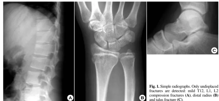 Fig. 2. Chest X-rays show diffuse infiltration in right upper and  middle lobe (A) and improved state (B)