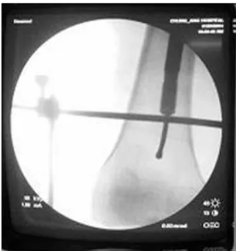 Fig. 3. Fluoroscopy shows that Steinmann pin prevent the reaming of the femur. 