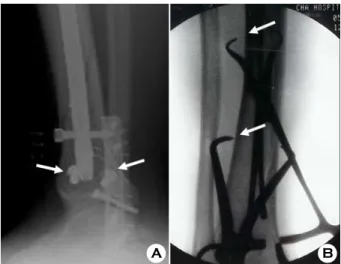 Fig. 4. The associated fractures of  the distal fibula is reduced and fixed if  it will disturb the ankle mortise