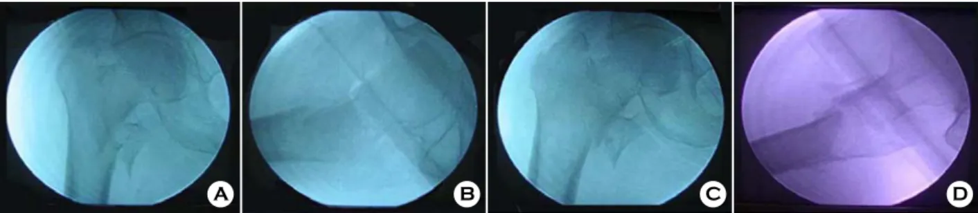 Fig. 1. Intraoperative radiographs show the technique of  reduction. 