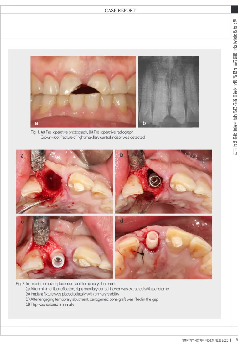 Fig. 2. Immediate implant placement and temporary abutment