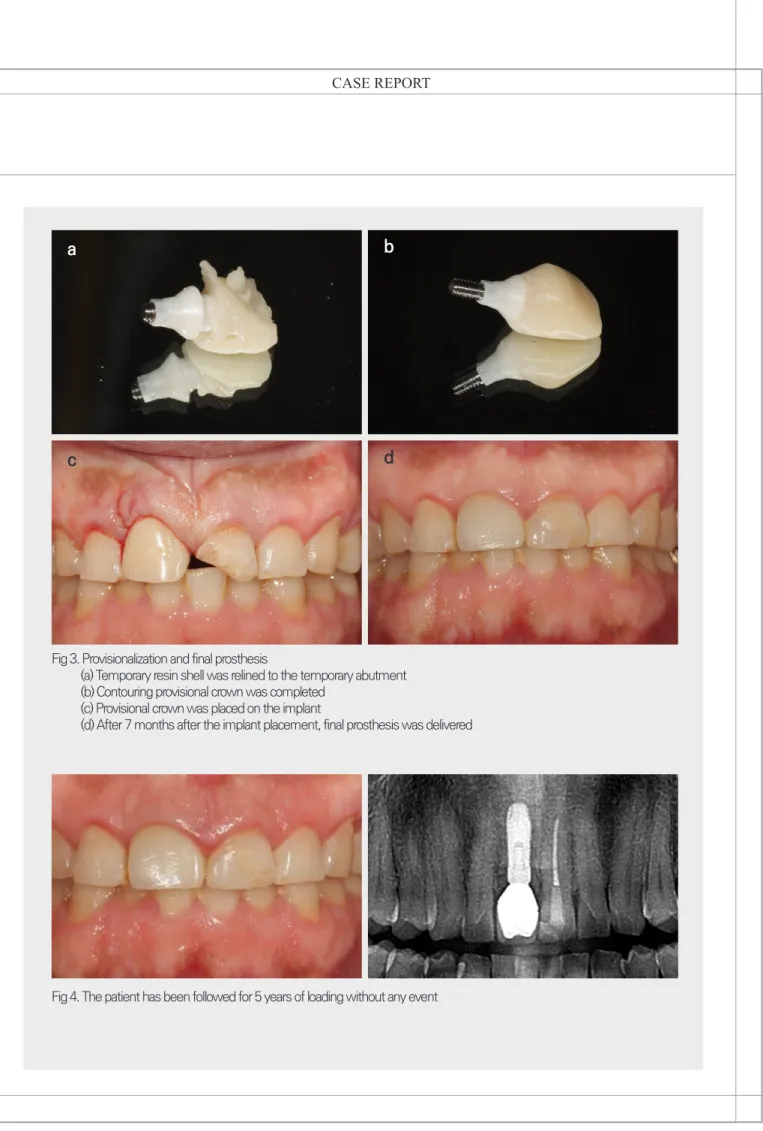 Fig 3. Provisionalization and final prosthesis