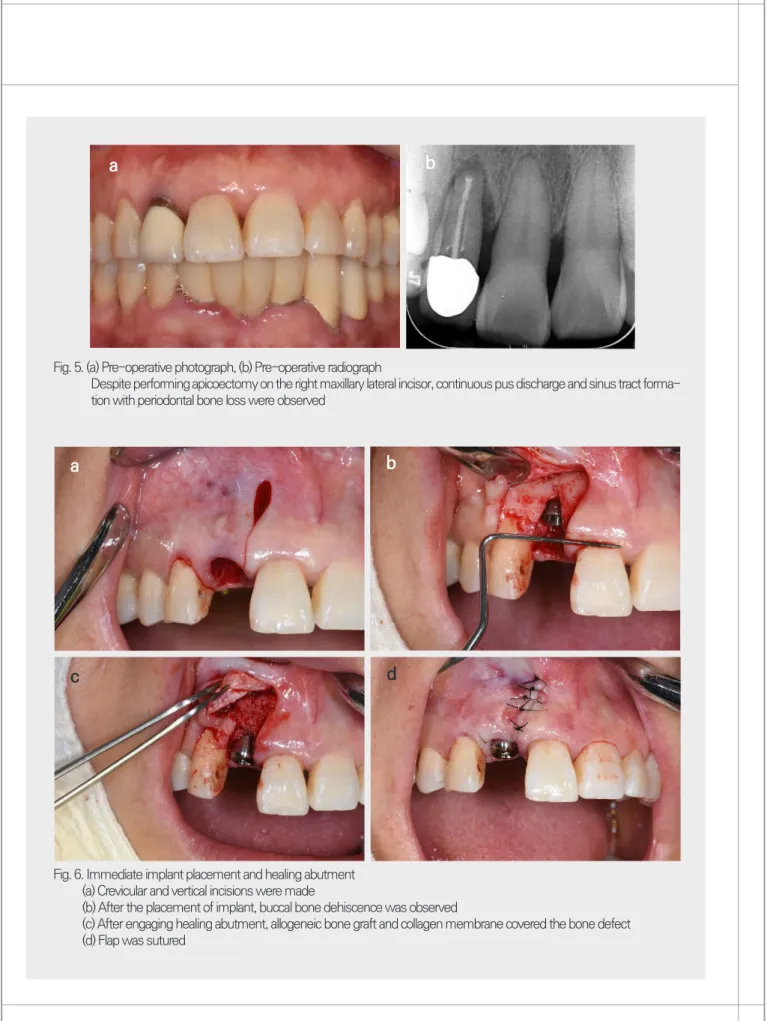 Fig. 6. Immediate implant placement and healing abutment           (a) Crevicular and vertical incisions were made 