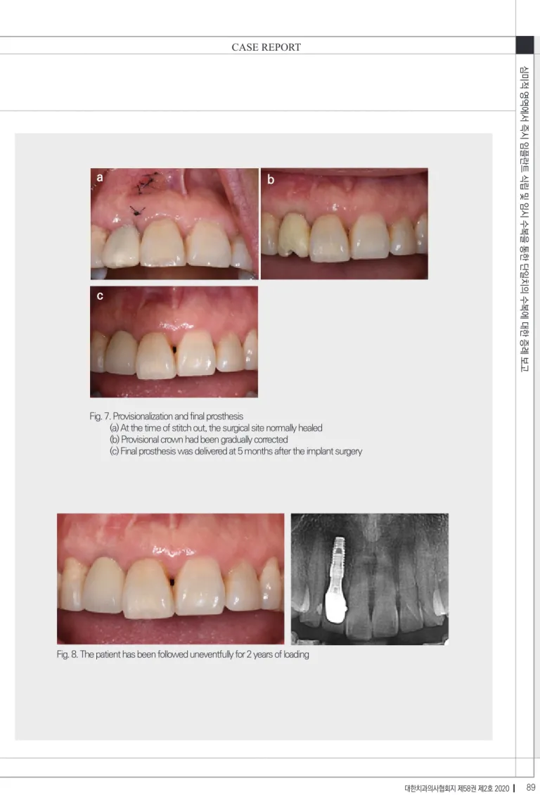 Fig. 7. Provisionalization and final prosthesis