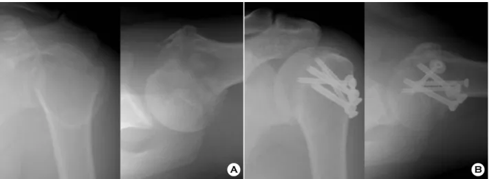 Fig. 1. A 44-year-old man treated with open reduction and internal fixation. 